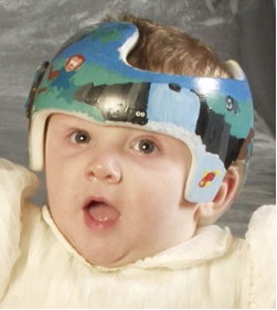 Infant Cranial Soft Spots